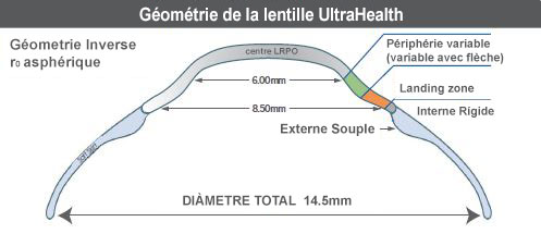 vaulted lens design FR